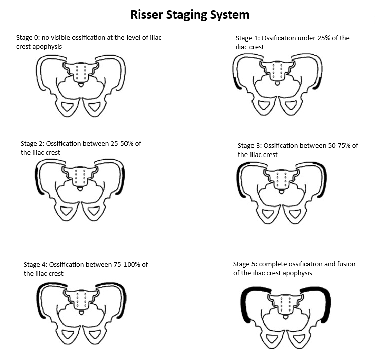 Sanders Vs Riser Spine What Is the Risser Stage in Scoliosis? | Dr. Sardar